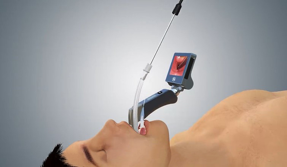 Zor Entübasyon için 2022 Sıcak Satış Sterilize Video Yardımlı Laringoskop